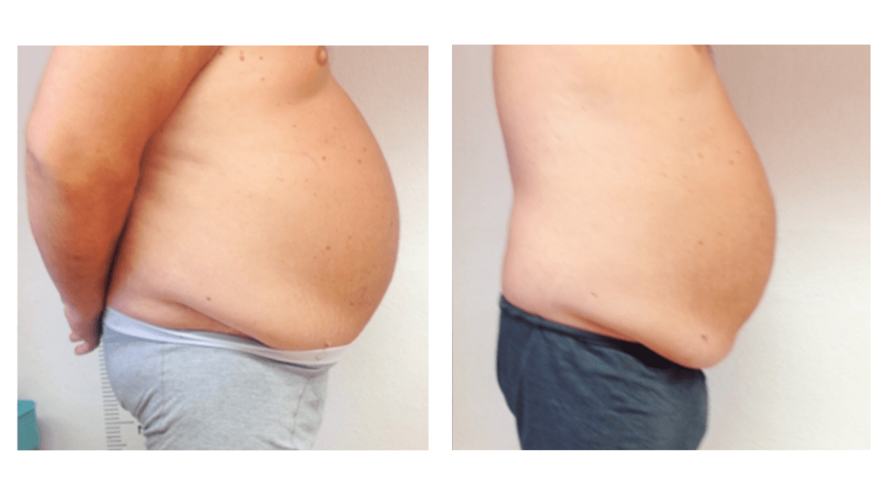Before and after weight loss side view.