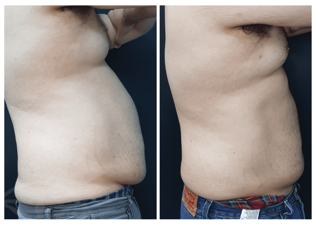 Before and after side profile body transformation.